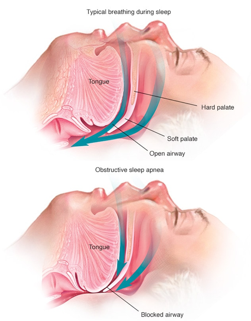 Deciphering Idiopathic Hypersomnia: Challenges and Innovations in Clinical Practice