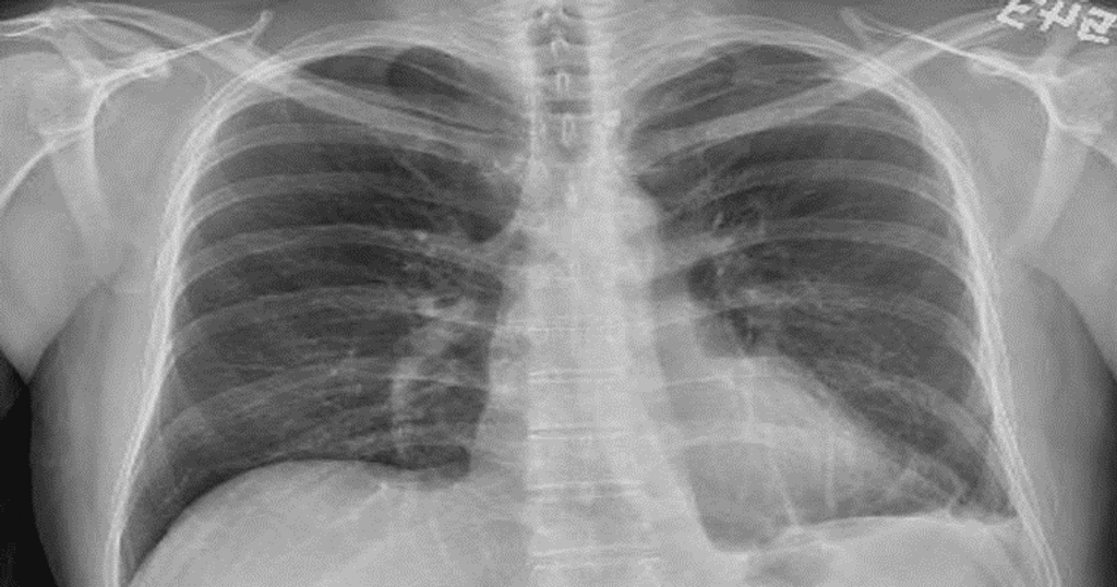 Unlocking the Dangers of Online Prescriptions: A Case of Hemothorax in Ehlers-Danlos Syndrome Patient After Sildenafil Use