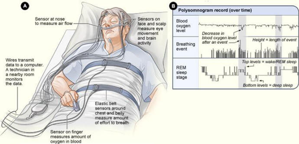 Deciphering Idiopathic Hypersomnia: Challenges and Innovations in Clinical Practice