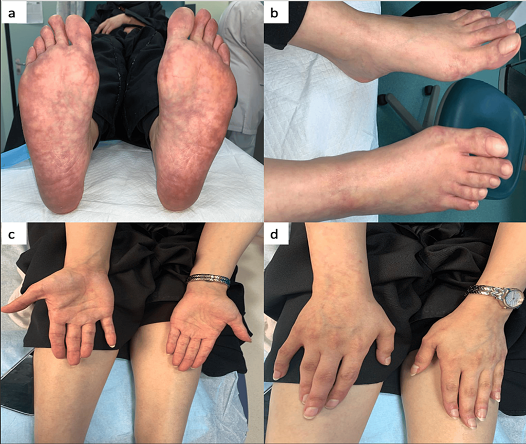 Bridging Dermatology and Neurology: Exploring the Complexities of Sneddon Syndrome