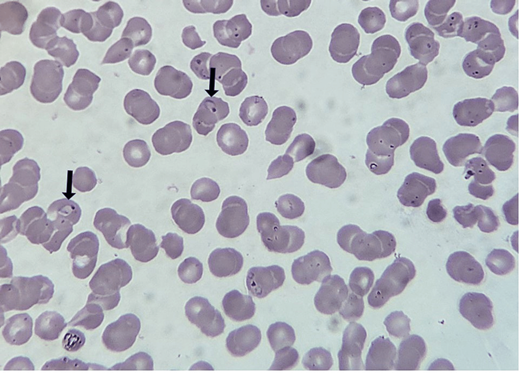 Falciparum Malaria, Leptospirosis, and Vibrio mimicus Encephalitis