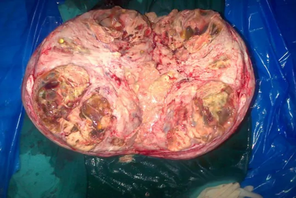 Largest Uterine Tumor