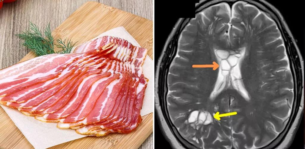 Neurocysticercosis