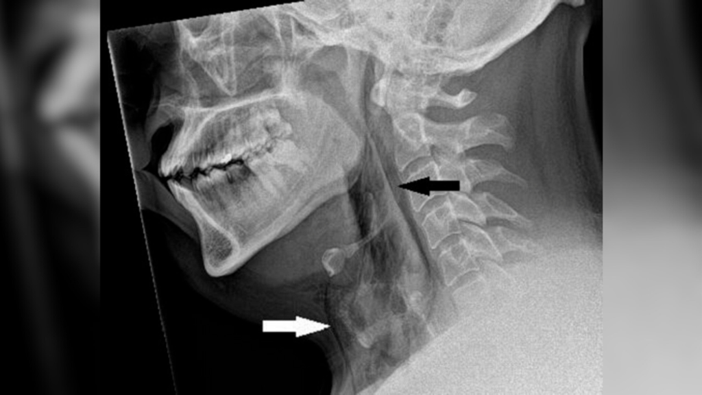 Holding in a Sneeze: A Case of Spontaneous Windpipe Tear