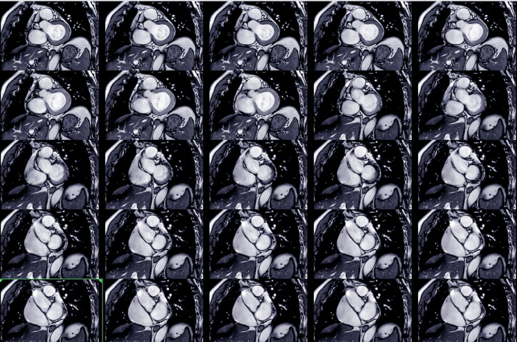 Non-Invasive Heart Risk Assessment: A New Era