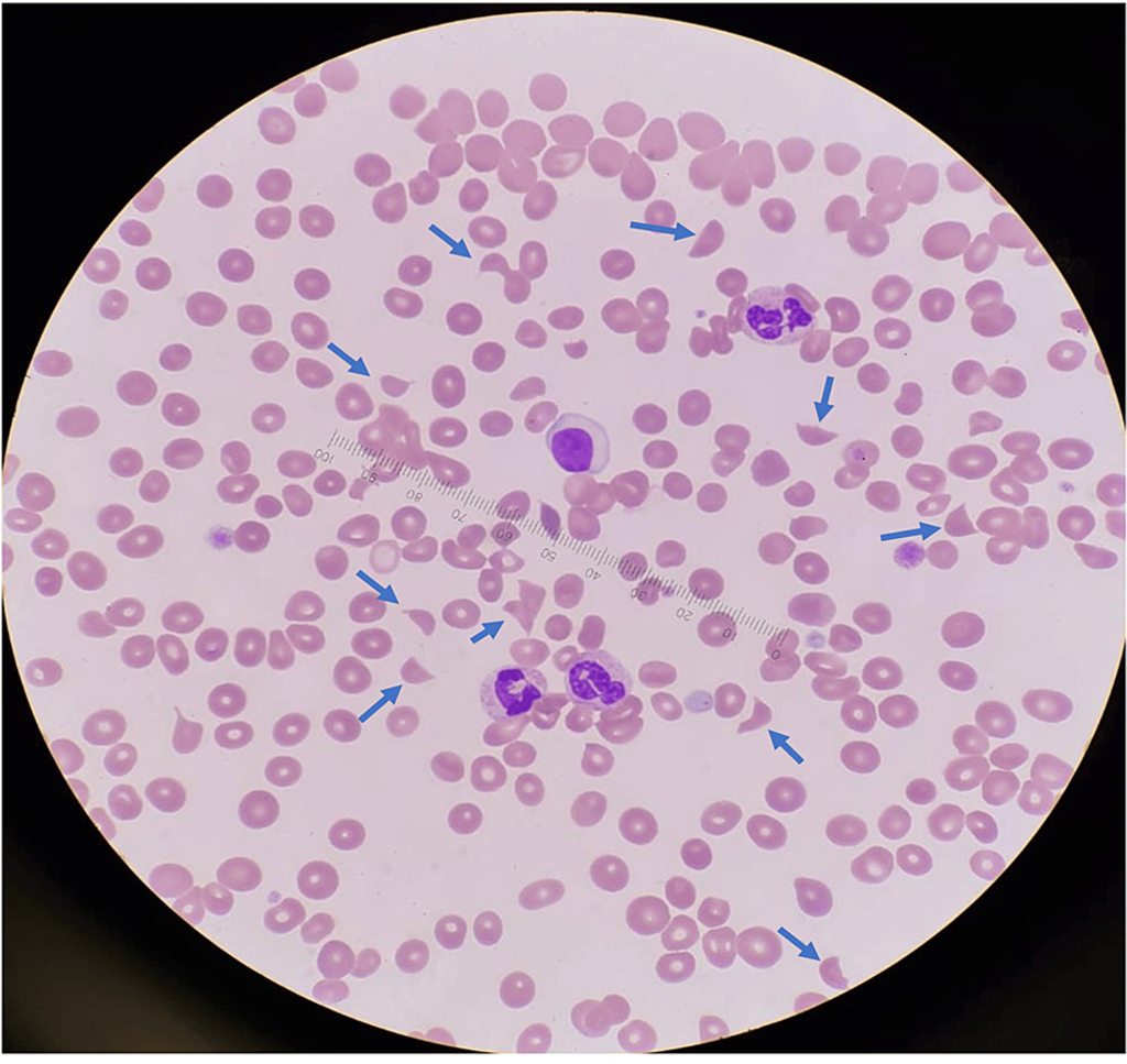 Atypical hemolytic uremic syndrome (aHUS)