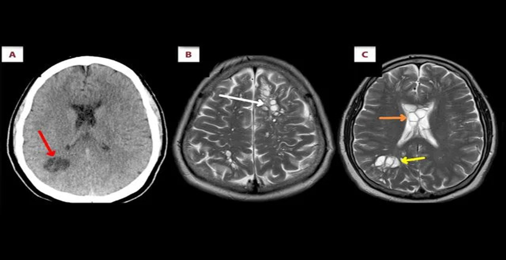 Neurocysticercosis