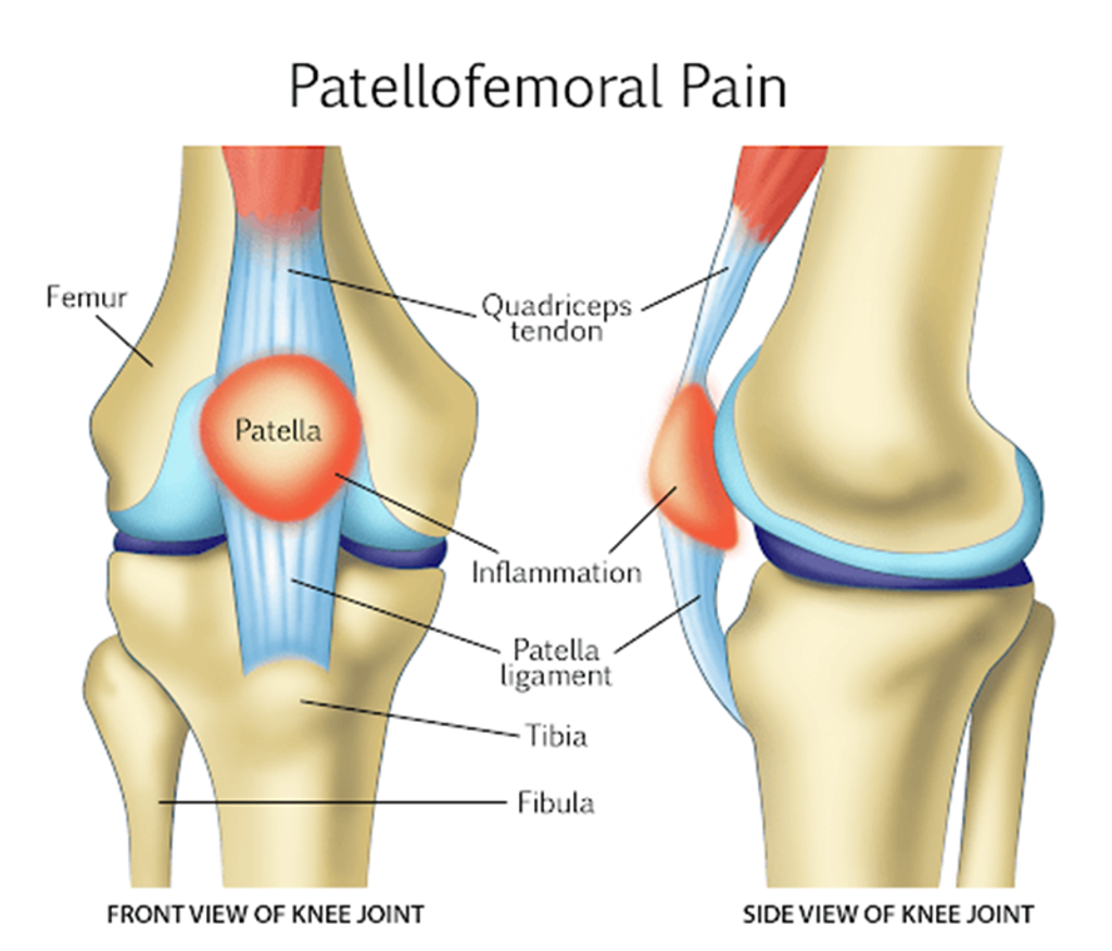 Addressing Anterior Knee Pain: Strategies for Successful Management of Patellofemoral Syndrome