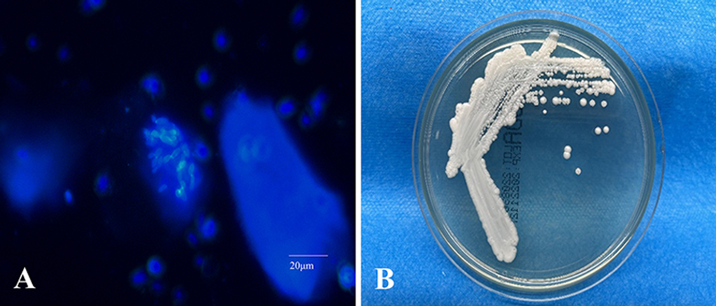 Unusual Pigmentation in Superficial Fungal Infections: A Closer Look at Non-Albicans Candida Species