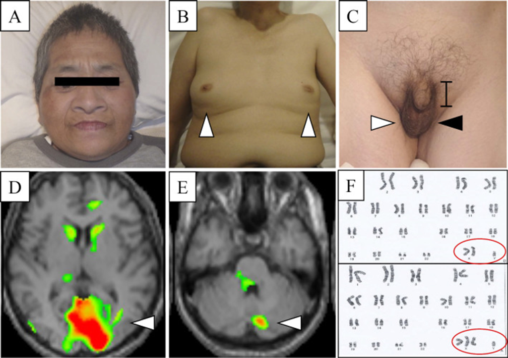 Klinefelter Syndrome