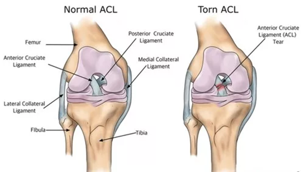 ACL Injury