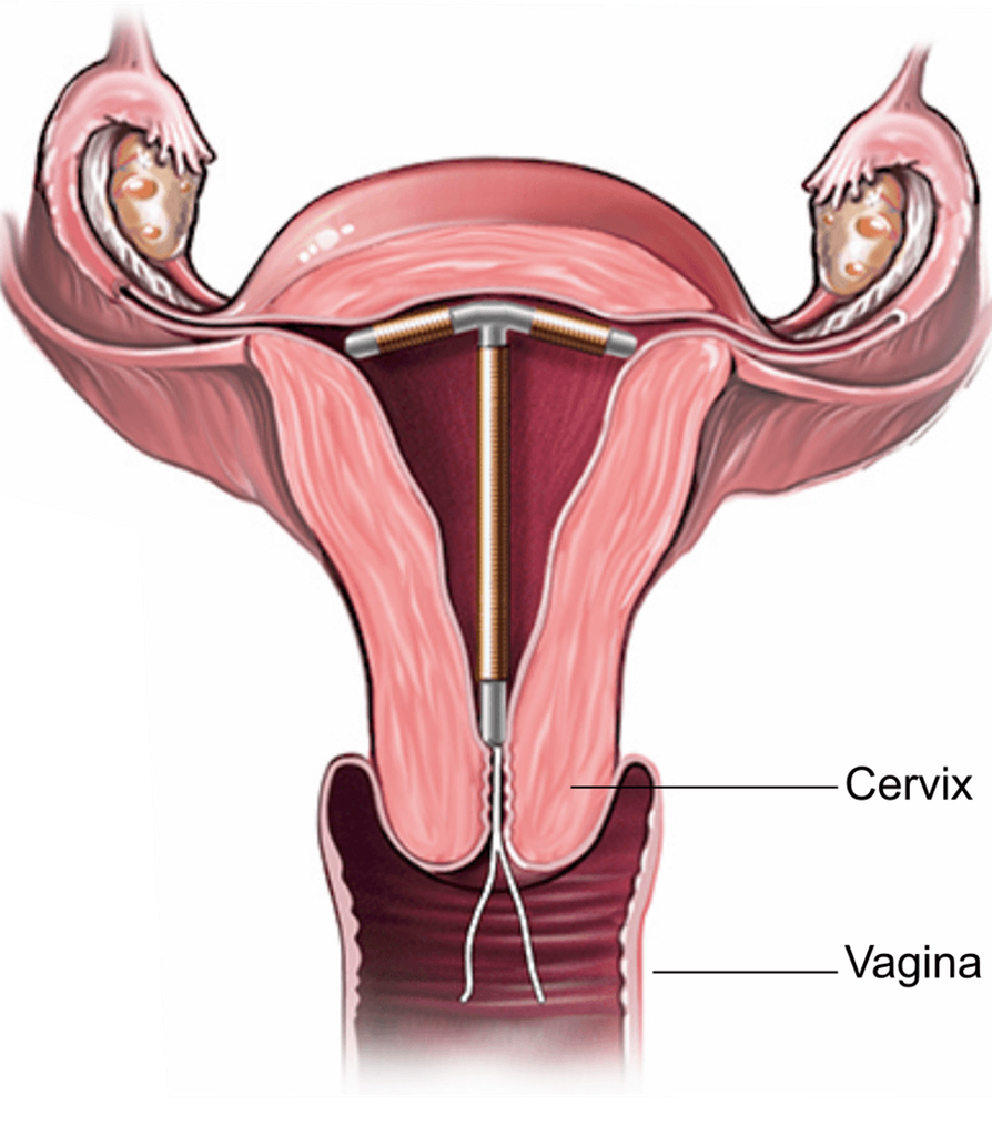 Bladder migration