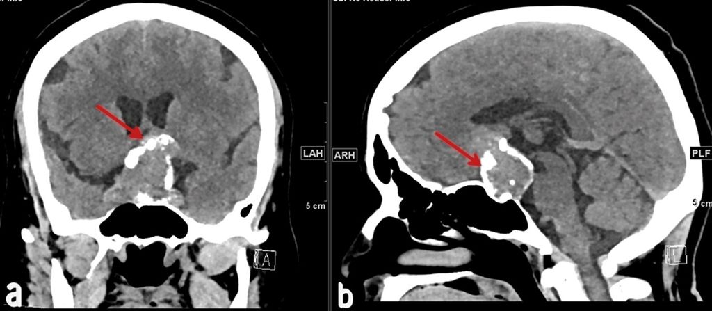 Deciphering Calcified Pituitary Adenoma from Craniopharyngioma: A Case Report and Diagnostic Challenge