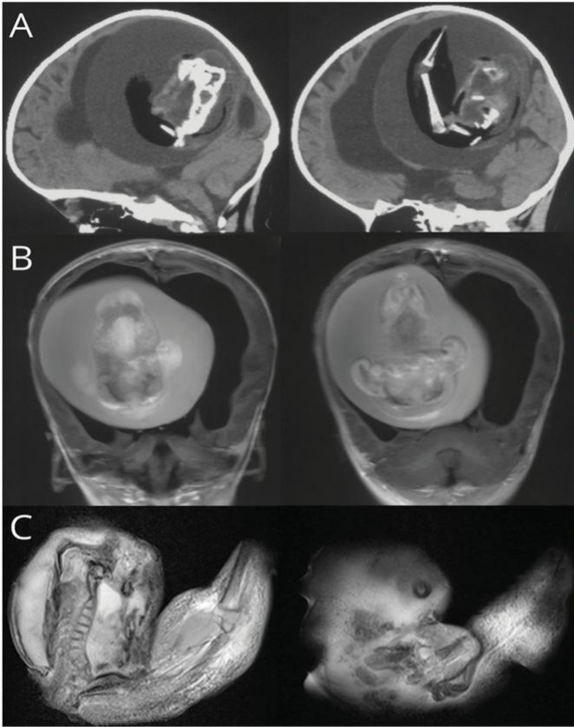 Fetus in Fetu