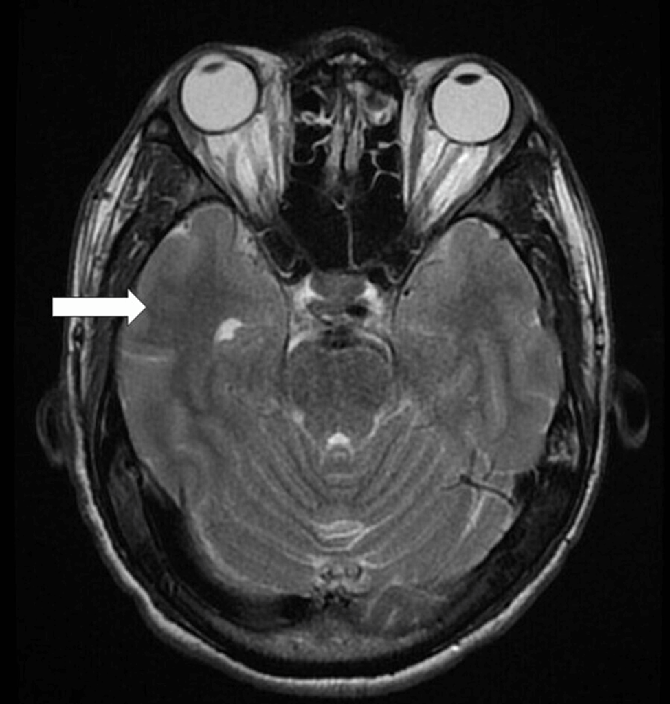 Falciparum Malaria, Leptospirosis, and Vibrio mimicus Encephalitis