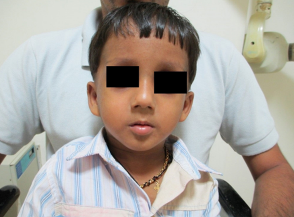 Sotos Syndrome