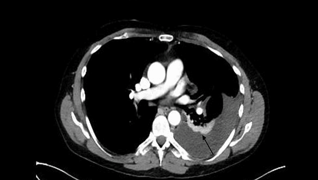 Unlocking the Dangers of Online Prescriptions: A Case of Hemothorax in Ehlers-Danlos Syndrome Patient After Sildenafil Use