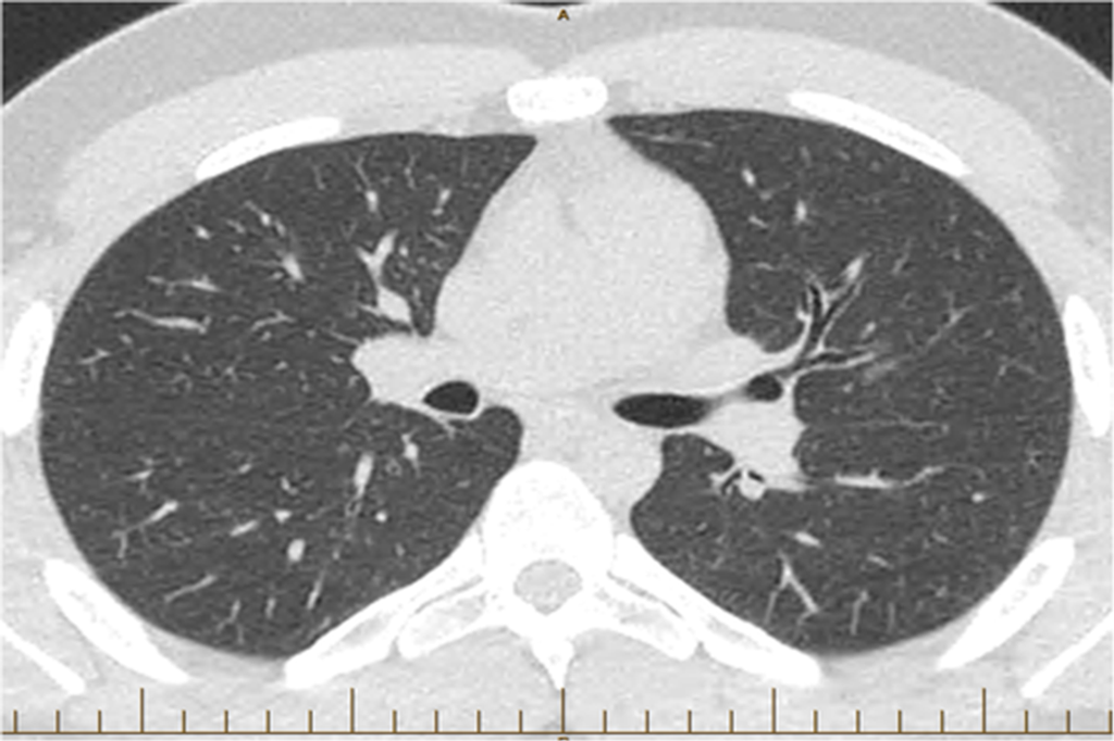 Hot Tub Lung and Environmental Mycobacteria