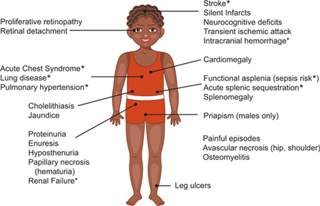 Sickle Cell Disease Guideline