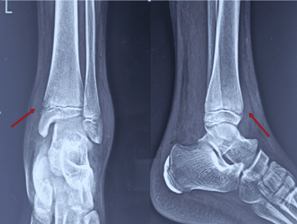 Pediatric Fungal Osteomyelitis