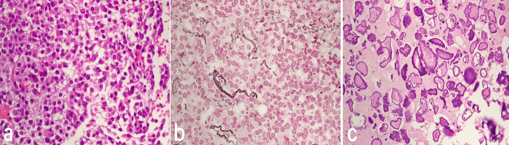 Deciphering Calcified Pituitary Adenoma from Craniopharyngioma: A Case Report and Diagnostic Challenge