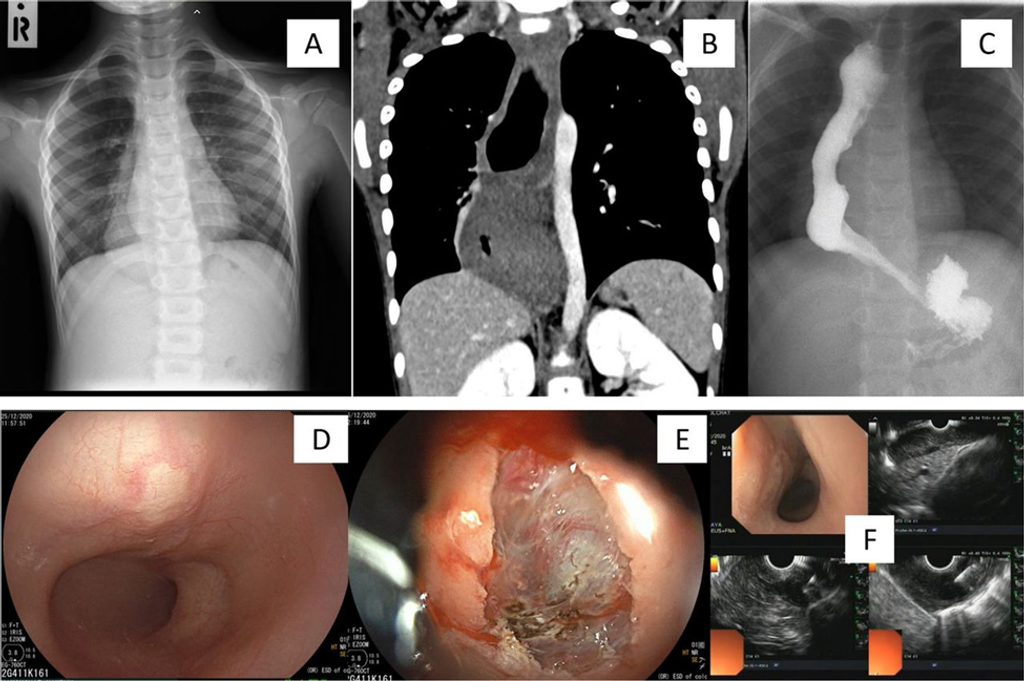 Navigating Paediatric Oesophageal Leiomyomatosis with Alport Syndrome