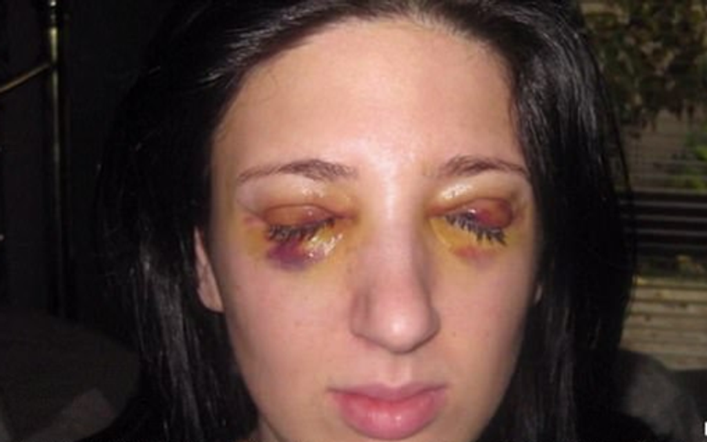 Mysterious Condition Leaves Woman Unable to Open Her Eyes For Days