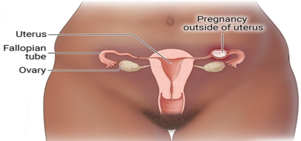 Fetus Turns to Stone - Lithopedion