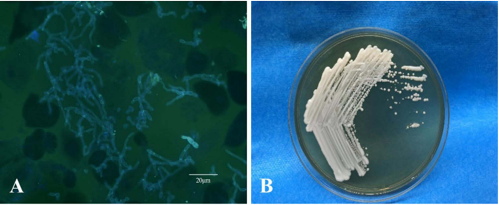 Unusual Pigmentation in Superficial Fungal Infections: A Closer Look at Non-Albicans Candida Species