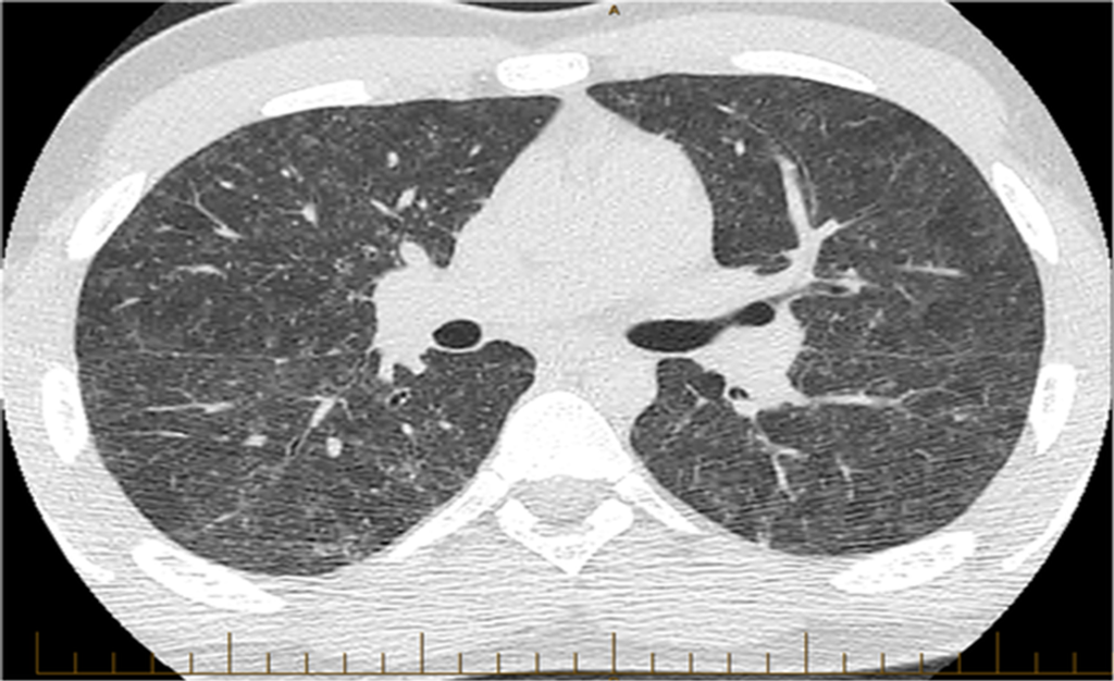 Hot Tub Lung and Environmental Mycobacteria