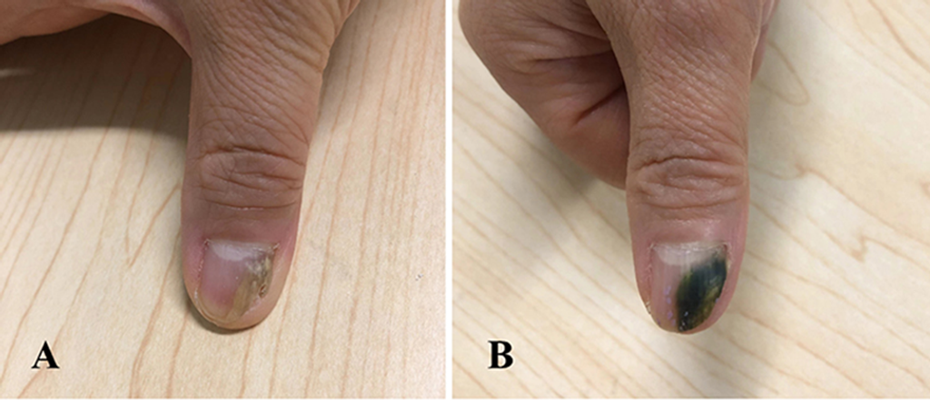 Unusual Pigmentation in Superficial Fungal Infections: A Closer Look at Non-Albicans Candida Species