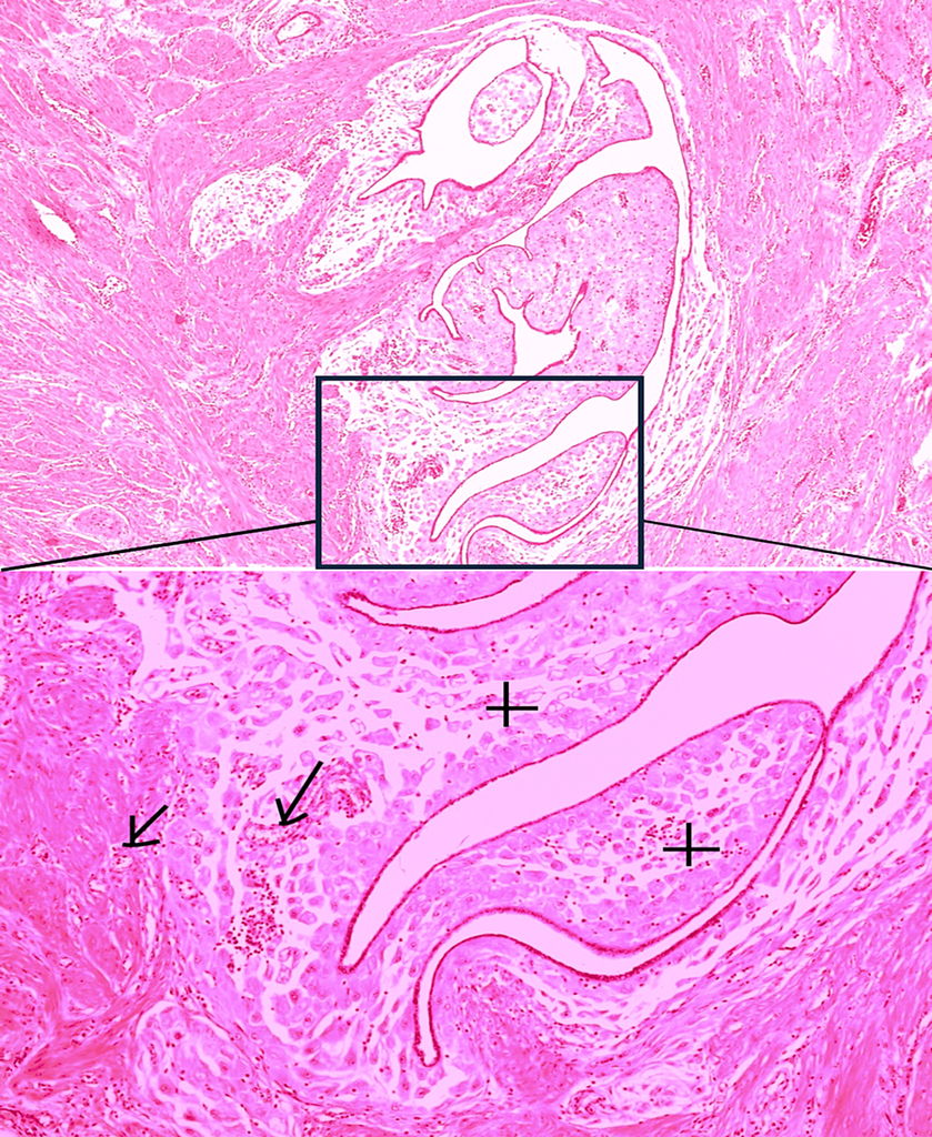 Spontaneous Hemoperitoneum and Adenomyosis