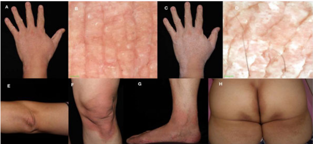 Aquagenic Syringeal Acrokeratoderma (ASA)